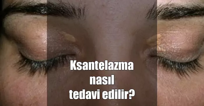 Ksantelazma Tedavisi (Göz Kapağı Üstünde Yağ Bezesi) ksantelazma tedavisi nasıl yapılır