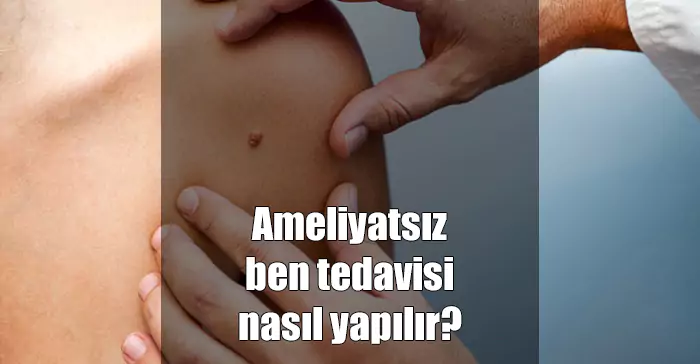 ameliyatsız ben tedavisi nasıl yapılır