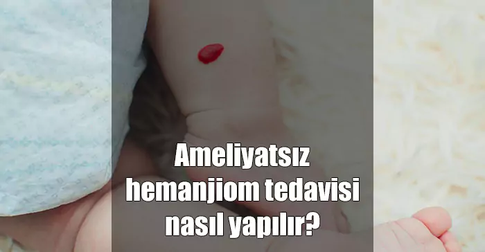 Hemanjiom Nedir? Nasil Tedavi Edilir? ameliyatsız hemanjiom tedavisi