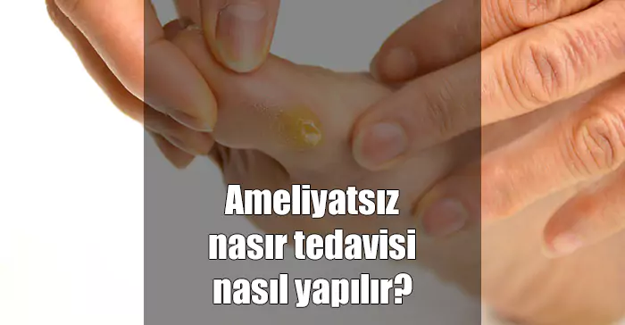 Ameliyatsız Nasır Tedavisi 3 Dakikada Yapılabilir ameliyatsız nasır tedavisi nasıl yapılır
