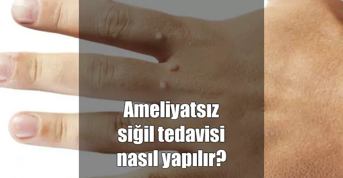 Siğil Nedir, Bulaşıcı mıdır? Ameliyatsız Siğil Tedavisi Nasıl Yapılır? ameliyatsız siğil tedavisi