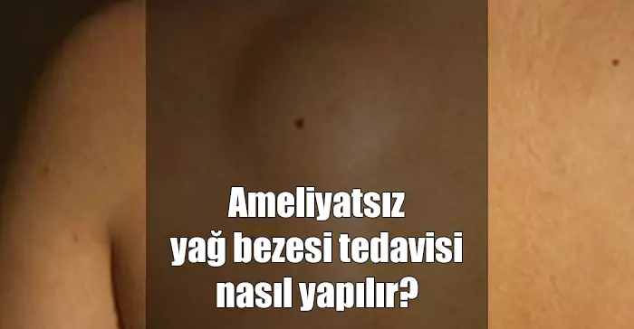 Lipom Nedir, Neden Olur ve Nasıl Tedavi Edilir? ameliyatsız yağ bezesi tedavisi
