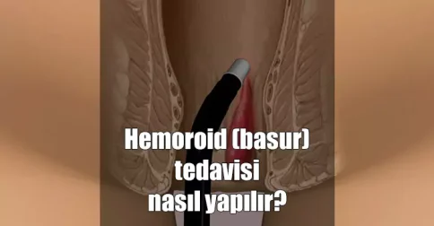 hemoroid basur tedavisi nasıl yapılır