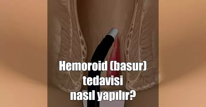 Ameliyatsız Basur Tedavisi hemoroid basur tedavisi nasıl yapılır