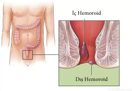 hemoroid çeşitleri