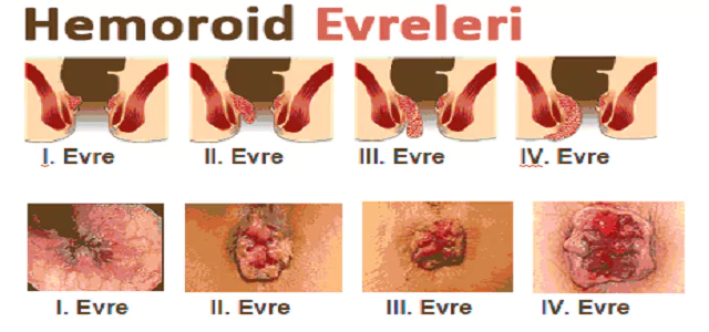 hemoroid evreleri