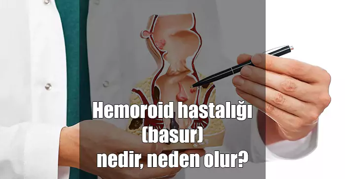 hemoroid basur nedir neden olur