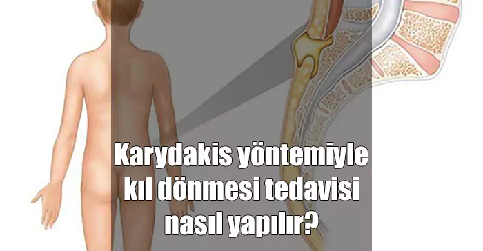 karydakis yöntemiyle kıl dönmesi tedavisi