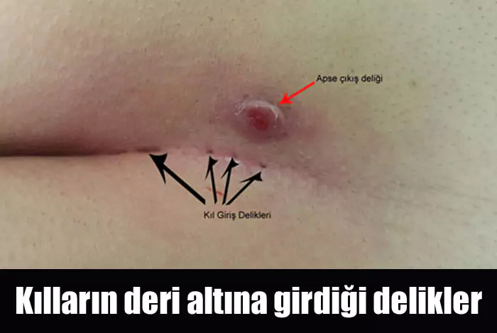 kıl dönmesi belirtileri nelerdir