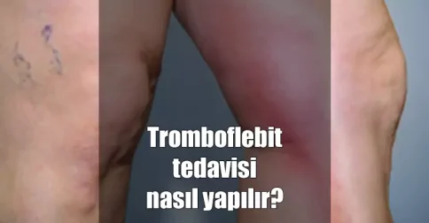 tromboflebit tedavisi nasıl yapılır