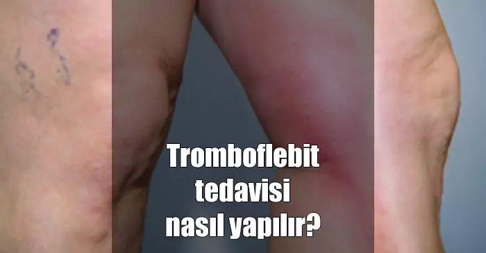 Tromboflebit Nedir? Nasıl Tedavi Edilir? tromboflebit tedavisi nasıl yapılır