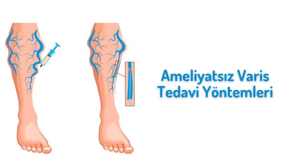 Ameliyatsız Varis Tedavi Yöntemleri Güncel Bilgiler ameliyatsız varis tedavileri.jpg